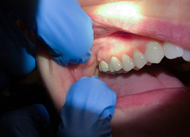Best Emergency Dental Care for Abscessed Tooth in Montezuma, GA